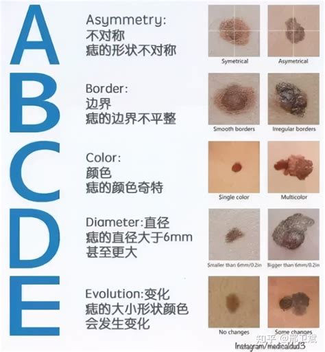 痣 顏色|是痣還是癌？醫師以ABCDE原則教你辨識